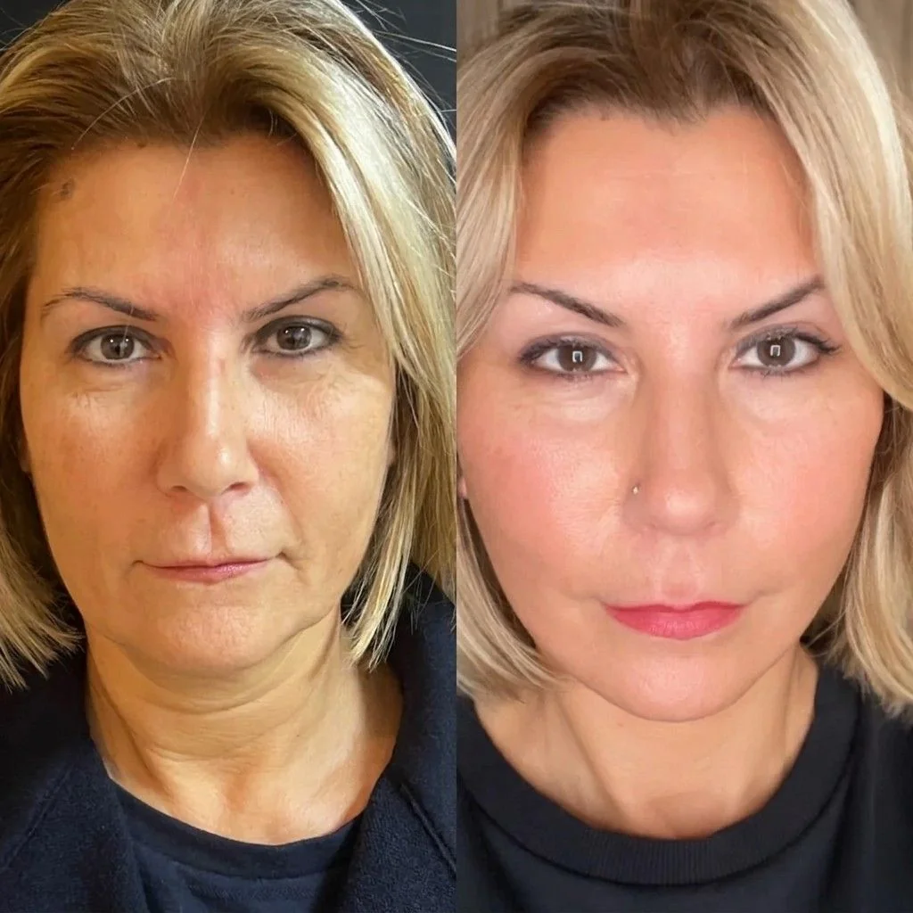 Facial HIFU — before and after
