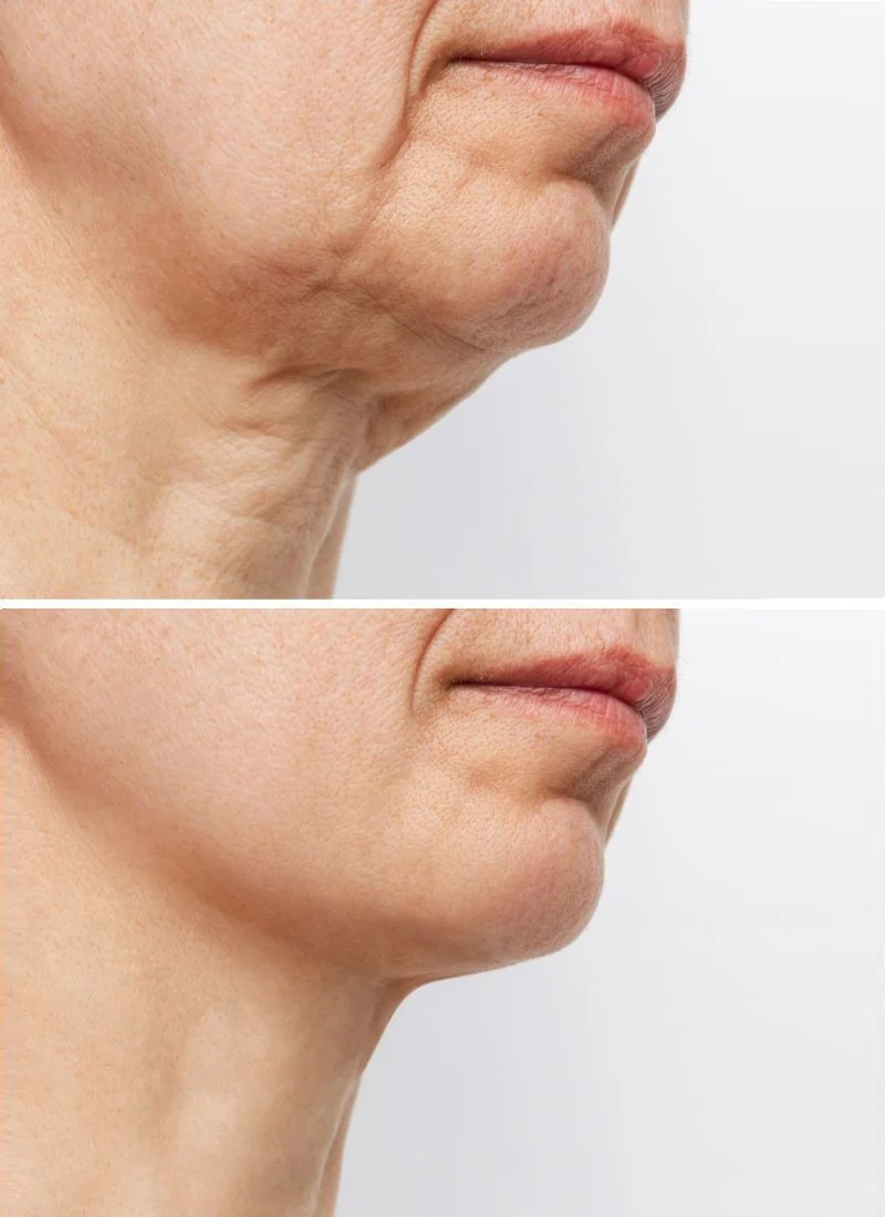 HIFU jowl — before and after