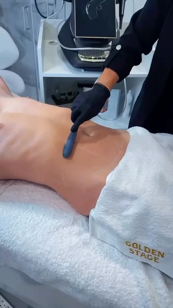 Body HIFU in session